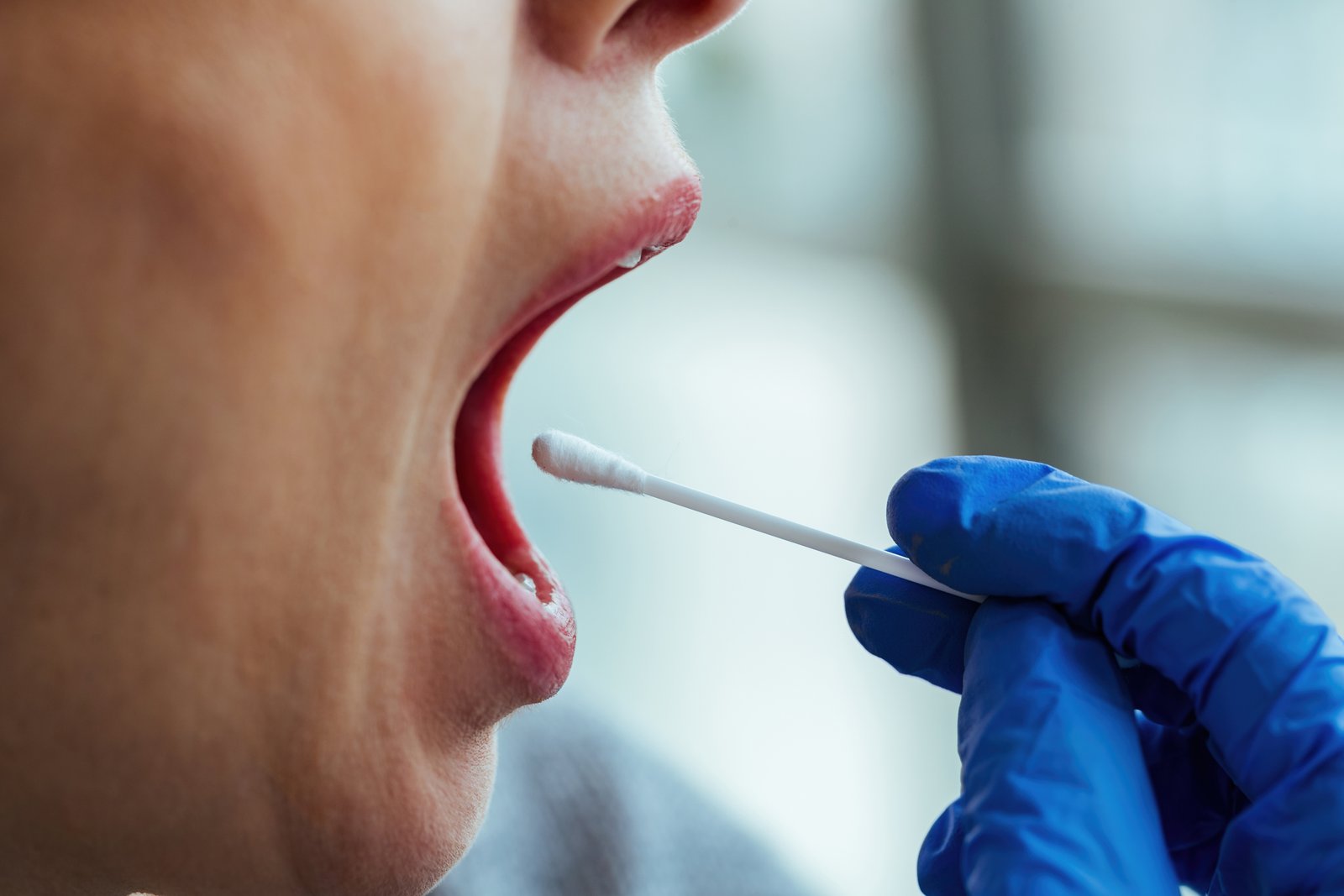 Image do post Estomatite: o que é essa inflamação que provoca feridas dolorosas na boca?